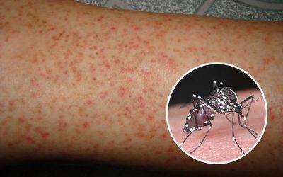 Trẻ bị sốt xuất huyết có những dấu hiệu này cần đưa đi viện ngay
