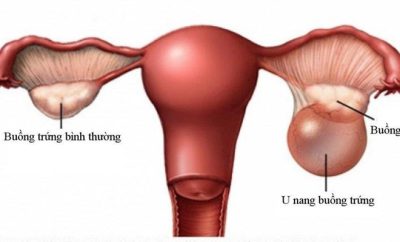U nang buồng trứng – căn bệnh nguy hiểm chị em cần lưu ý! 