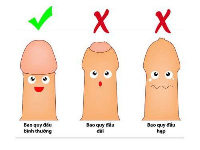 Hẹp bao quy đầu ở trẻ sơ sinh