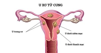 U xơ tử cung – khi nào cần phẫu thuật?