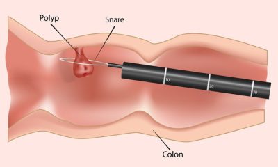 Đối tượng nào thì cần tầm soát ung thư đại tràng?