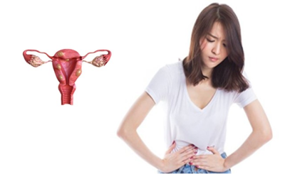 Bệnh nhân u xơ tử cung kiêng ăn gì?