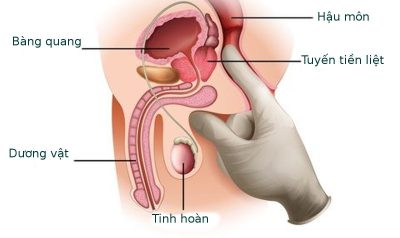 Nam giới đi tiểu có 3 dấu hiệu dưới đây phải đi khám ngay kẻo ung thư tuyến tiền liệt
