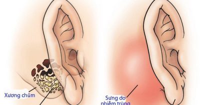 7 bước chăm sóc bệnh nhân sau phẫu thuật viêm tai xương chũm