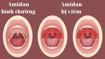 Bệnh amidan có lây không – Chuyên gia nhiều năm kinh nghiệm giải đáp