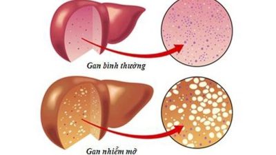 Gan sẽ gặp những vấn đề gì khi uống nhiều rượu bia
