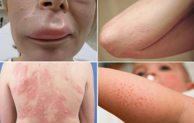 Bệnh dị ứng thời tiết không thể chủ quan lúc giao mùa