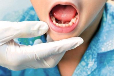 Dính thắng lưỡi ở trẻ và những điều cần biết.