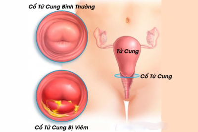 Những dấu hiệu cảnh báo viêm cổ tử cung