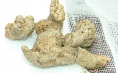 Mổ lấy sỏi san hô cho cụ bà 78 tuổi