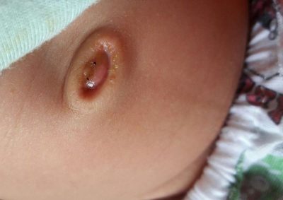 Những bất thường ở rốn trẻ sơ sinh cần chú ý