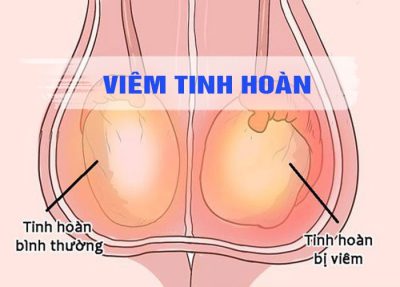 Ngỡ ngàng với khối u tinh hoàn hơn 4kg của người đàn ông U70