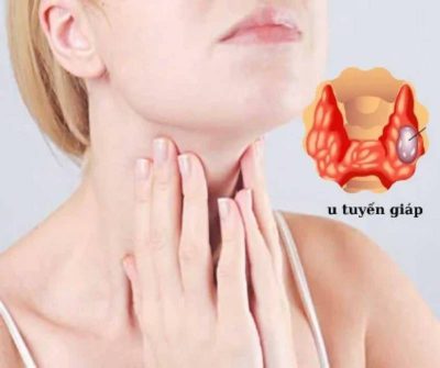 U tuyến giáp có mấy loại, nguy hiểm hay không?