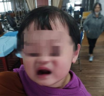Bé gái 2 tuổi bị méo miệng sau khi được bố mẹ chở đi chơi vào tối muộn