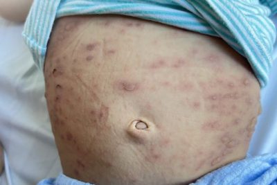 Bé trai nổi hàng trăm mụn nước do bệnh hiếm