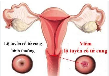 Dấu hiệu nhận biết viêm lộ tuyến cổ tử cung