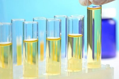 Nước tiểu có mùi bất thường là dấu hiệu bệnh gì