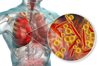 Cẩn trọng với biến chứng nguy hiểm của Viêm phổi do Mycoplasma