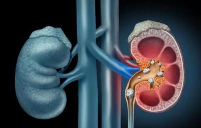 3 thói quen vô tình thành ‘hung thủ’ gây sỏi thận, nhiều người mắc phải