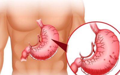 Đừng thờ ơ với biểu hiện cuả viêm loét dạ dày.