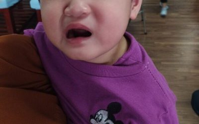 Bé 4 tuổi nhập viện vì liệt dây thần kinh số 7 do trời lạnh