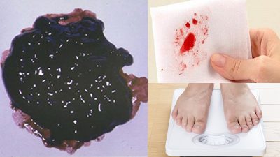 Xuất huyết tiêu hóa ở trẻ sau Tết: Không thể xem nhẹ