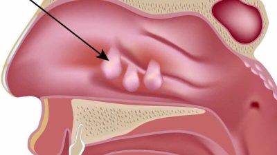 Những hiểu biết về bệnh polyp ở mũi và cách điều trị hiệu quả