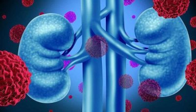 Những dấu hiệu cảnh báo nguy cơ bị ung thư thận