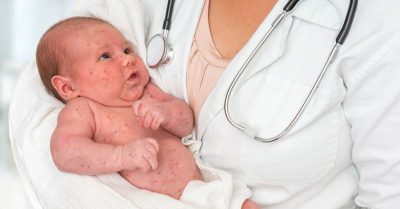 Rubella bẩm sinh nguy hiểm thế nào?