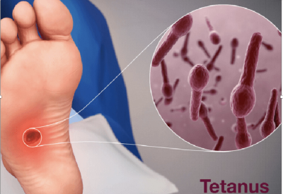 Cảnh báo nguy hiểm của bệnh uốn ván – Chớ nên chủ quan