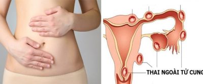 Phải làm gì khi mang thai ngoài tử cung