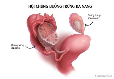 Có nhiều trứng nhưng không thể thụ thai – căn bệnh khiến nhiều phụ nữ khó có con
