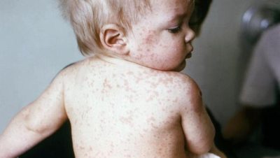 Thời tiết chuyền mùa Xuân: Cẩn trọng bệnh sởi ở trẻ