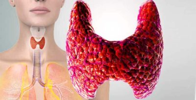 Viêm tuyến giáp Hashimoto: Viêm tuyến giáp phổ biến nhất