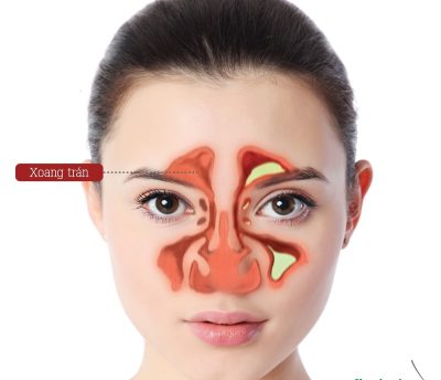 Viêm xoang trán có nguy hiểm không?