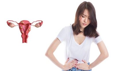 Phụ nữ bị u xơ tử cung kiêng ăn gì khi điều trị?