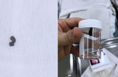 Cho con đi tắm suối, phụ huynh tá hỏa vì vắt sống trong mũi