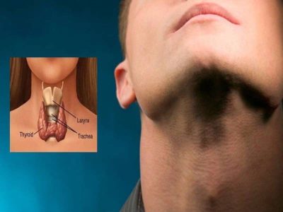 Các dấu hiệu sớm của ung thư tuyến giáp cần biết