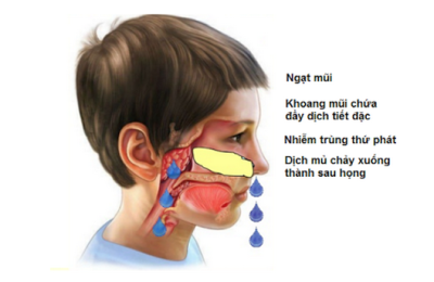 Viêm VA – Vì sao trẻ nào cũng mắc ít nhất vài lần, chữa trị thế nào