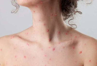 Bệnh thủy đậu ở người lớn- Không thể coi nhẹ