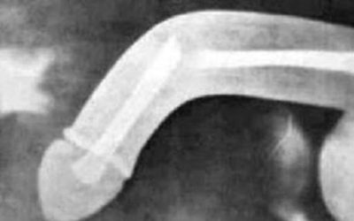 Thử ‘yêu’ tư thế mới, nhập viện cấp cứu vì gãy dương vật