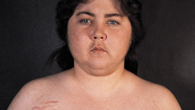 Hội chứng Cushing là gì, có nguy hiểm không?