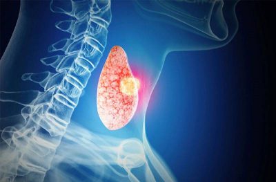 Nhân tuyến giáp: Những điều cần biết