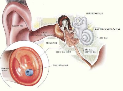 Phương pháp đặt ống thông khí trong điều trị viêm tai giữa