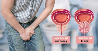Những loại viêm tuyến tiền liệt thường gặp