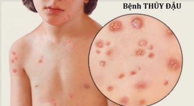 Trẻ bị thủy đậu rồi có thể bị mắc lại không?
