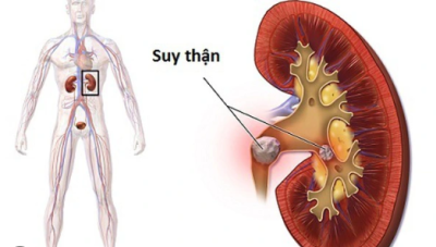 Cẩn trọng trước những tín hiệu cho thấy thận đang mất chức năng
