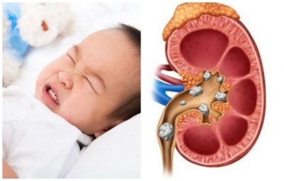 Sỏi thận ở trẻ: Nguyên nhân và triệu chứng
