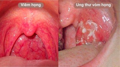 Triệu chứng ung thư vòm họng không thể bỏ qua