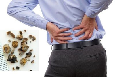 Tưởng đau ruột thừa hoá ra bị sỏi thận